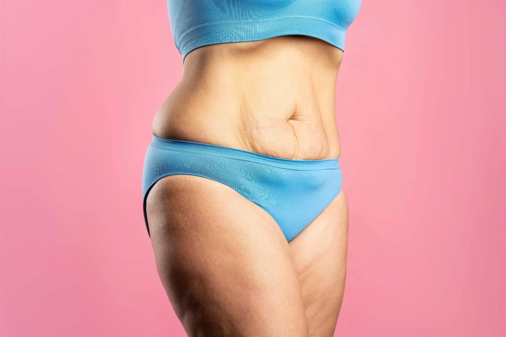 how-to-get-rid-of-cellulite-on-stomach
